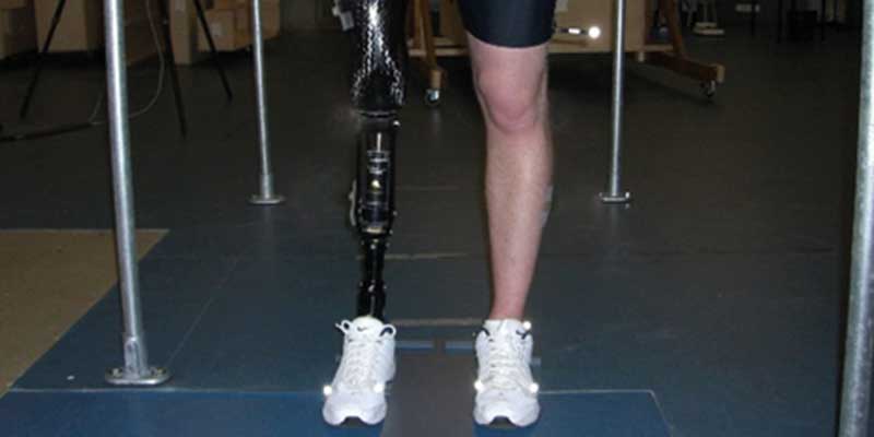 QuickFit - quick fitting of prosthetic sockets for above knee amputee.