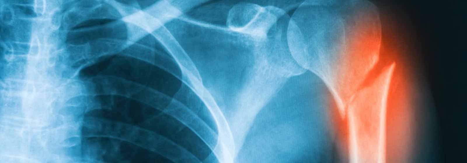 X-ray image of shoulder AP view